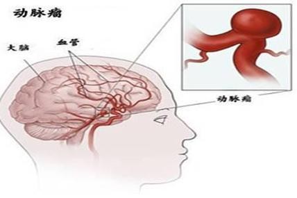 女孩夜场脑溢血怎么回事 女孩熬夜脑出血